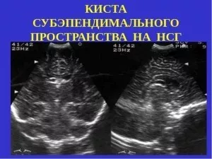 Диагностика кисты у новорожденных