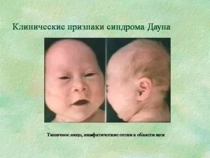 Распространенные признаки синдрома Дауна у новорожденных определяются по форме черепа