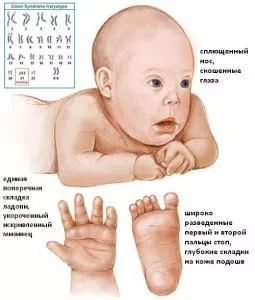 Признаки синдрома Дауна у новорожденных заключаются в сплющенном носе, характерными чертами ступней и ладоней
