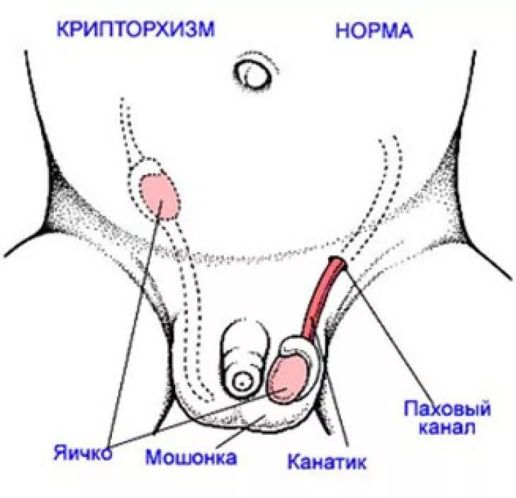Как выглядит созревшая половая система новорожденного и криптохизм, смотрите на фото