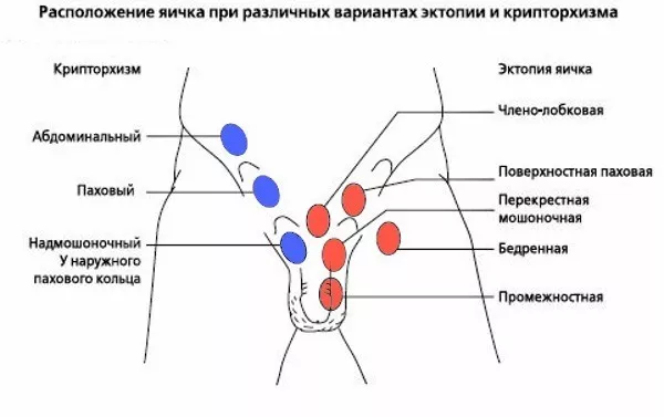Что нужно знать о криптохизме у детей грудного возраста и новорожденных
