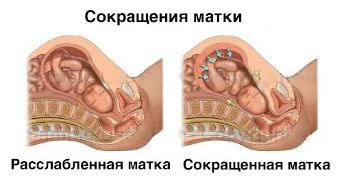 Опасен ли тонус матки при беременности