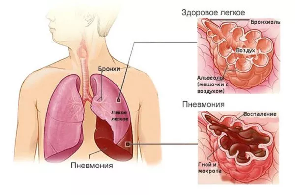Пневмония у грудничка: если ли шансы не заболеть?